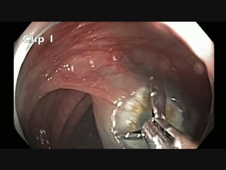 Transverse Colon - Flat Lesion - Enbloc Resection - unedited video
