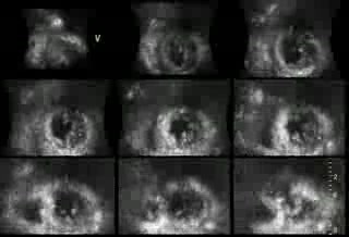 Antero-Septal Hypokinesia