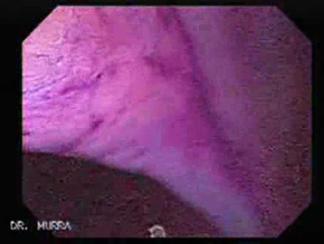 Flat Adenoma (3 of 3)