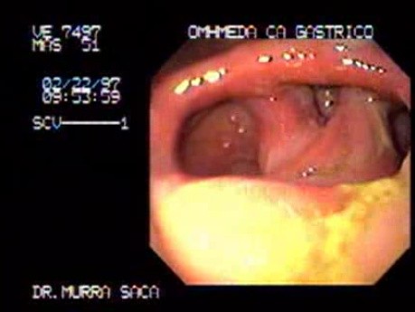 Pre - Pyloric Gastric Carcinoma - Endoscopy (2 of 2)