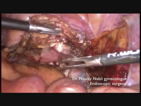 Sacrocolpopexy Using Harmonic Ace with Advanced Hemostasis