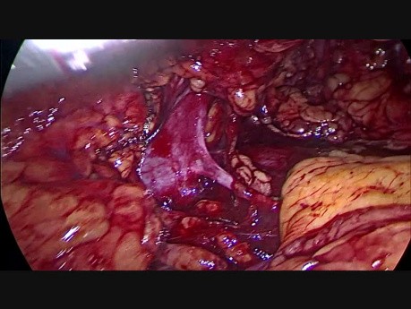 Transvaginal Laparoscopic Donor Nephrectomy