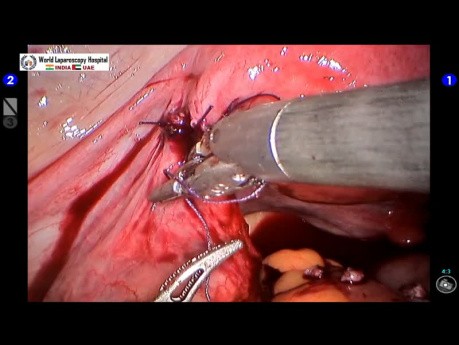 Robotic Reversal of Tubal Sterilization