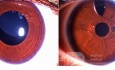 Lens Implantation in Megalocornea