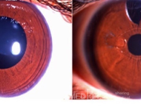 Lens Implantation in Megalocornea