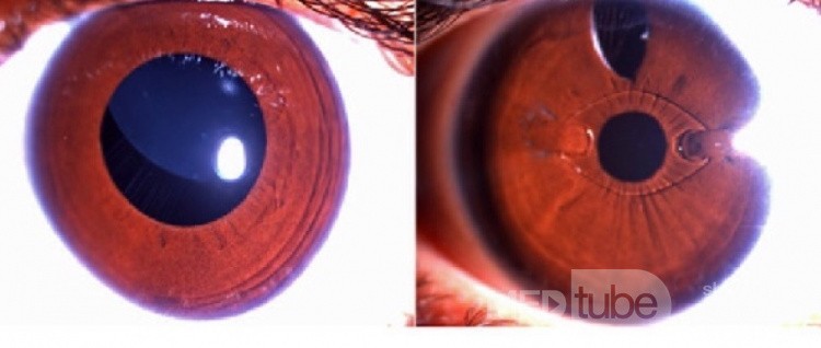 Lens Implantation in Megalocornea