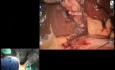 Robotic Cholecystectomy