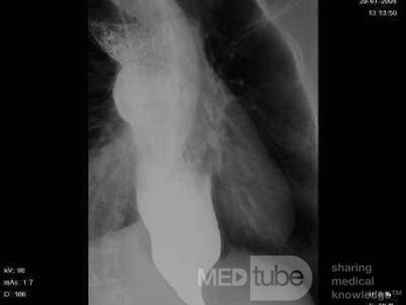 Esophageal Achalasia (2 of 10)