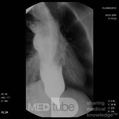 Esophageal Achalasia (2 of 10)
