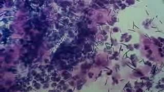 Lactobacillus acidophilus and leucocytosis - Pap smear