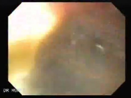Synchronous Cancer Gastric and Esophageal (1 of 9 )