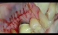Periodontal Microsurgery: Connective Tissue Grafting