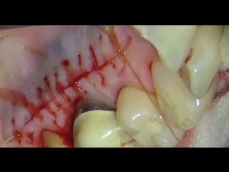 Periodontal Microsurgery: Connective Tissue Grafting