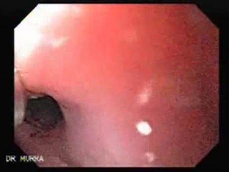 Esophageal Stricture After Total Gastrectomy And Chemoradiation - Application Of Mitomycin C - 1/2