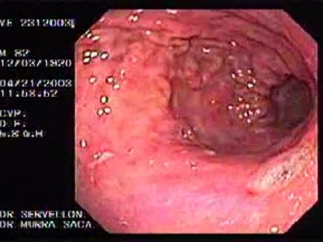 Acute Bleeding - Presence of Multiple Ulcers and Erosions