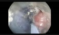ESD of Sigmoid Adenoma