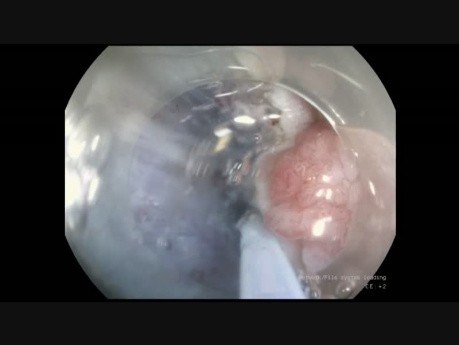 ESD of Sigmoid Adenoma