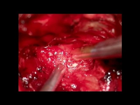 Basillary Impression