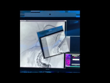 Novel Endoscopic and Interventional Radiology Combined Approach for the Treatment of Severe Bile Duct Injury