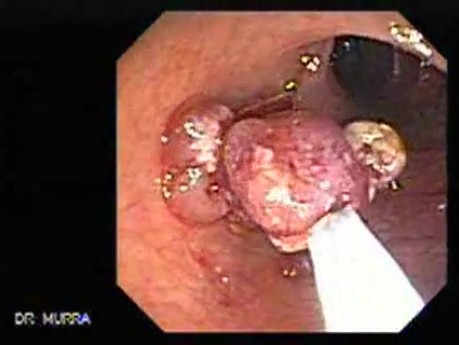 Polypectomy of Stalked Polyp (5 of 6)
