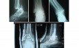 Trimalliolar fracture of Ankle