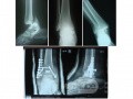 Trimalliolar fracture of Ankle