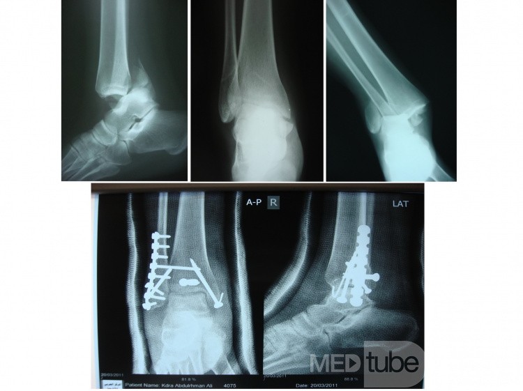 Trimalliolar fracture of Ankle