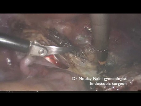 Total hysterectomy after open myomectomy