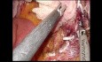 Single-port Laparoscopic Subtotal Duodenectomy with Duodenojejunostomy