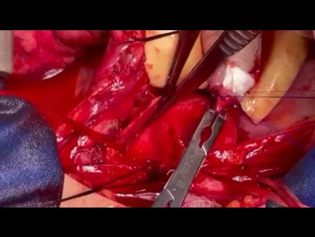 Simultaneous Ascending Aorta Replacement and Coarctation Repair with Bypass 