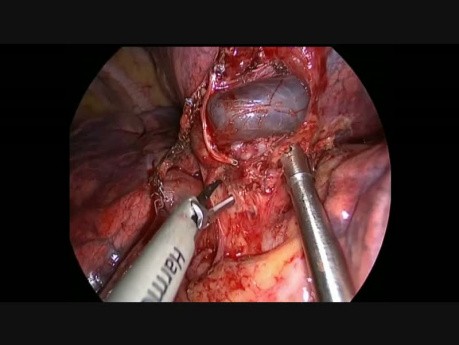 Uniportal Vats Lobectomy After Inmunotherapy With the Help of 3D Printed Model