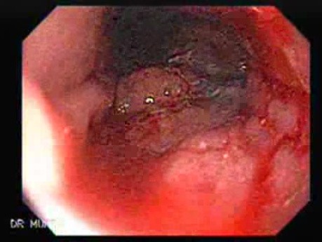 Gastric Lymphoma - Mucosa with the Signs of Small Bleeding