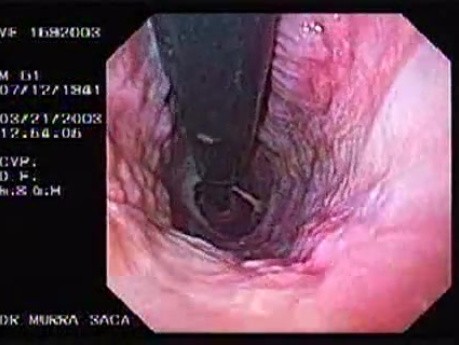 Banding of esophageal varices (2 of 17)