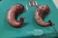 Part of the Stomach After Sleeve Gastrectomy