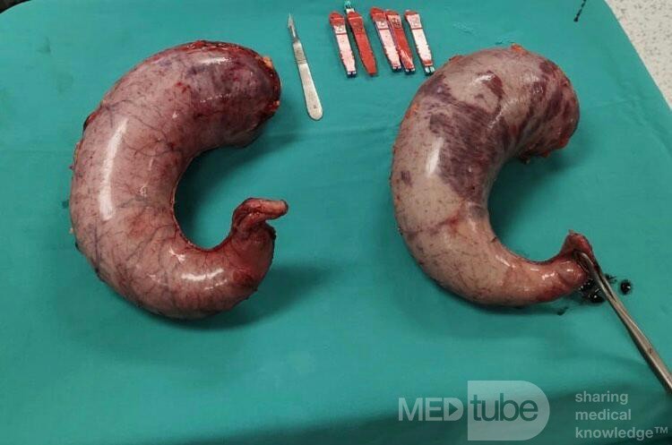 Part of the Stomach After Sleeve Gastrectomy