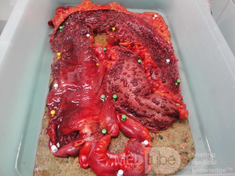 Multiple Rectal Ulcers (97 of 110)