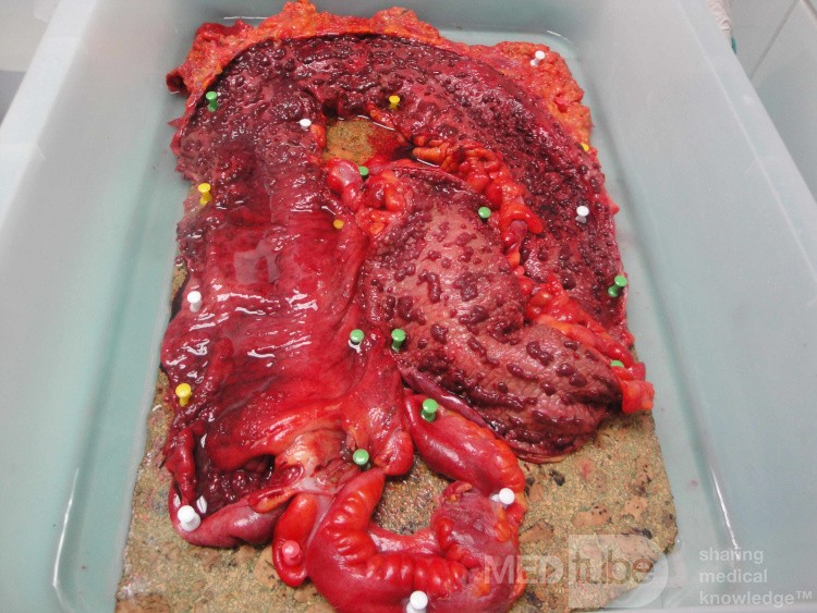 Multiple Rectal Ulcers (97 of 110)