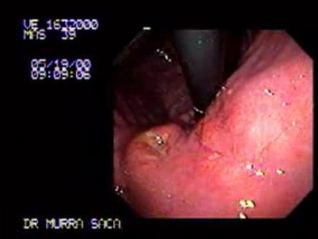 Extensive Gastric Adenocarcinoma - Endoscopy