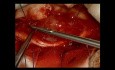 Intraspinal tumor