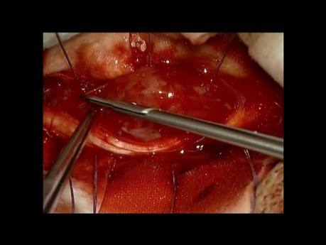 Intraspinal tumor