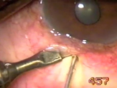 Sturge Weber Syndrome - Transconjunctival Transciliary Filtration