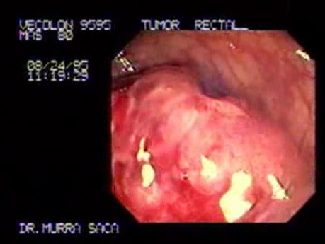 Enormous Sessile Adenoma Of The Rectum (1 of 2)