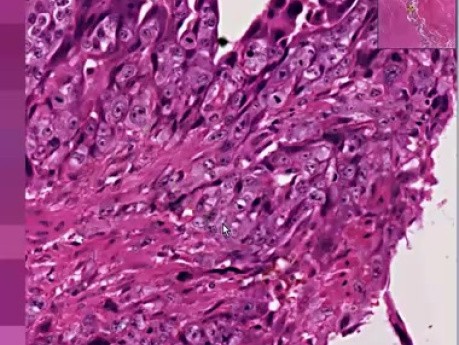 Choriocarcinoma