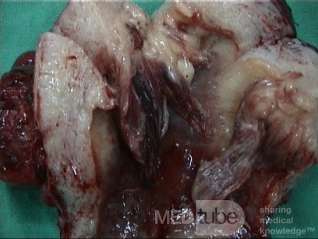 Sarcoma Uteri (Carcino Sarcoma)