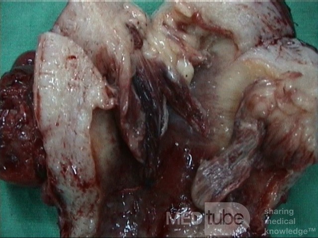 Sarcoma Uteri (Carcino Sarcoma)