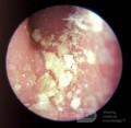 Psoriasis of the External Ear Canal