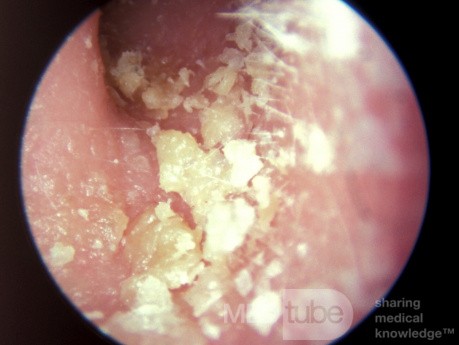 Psoriasis of the External Ear Canal