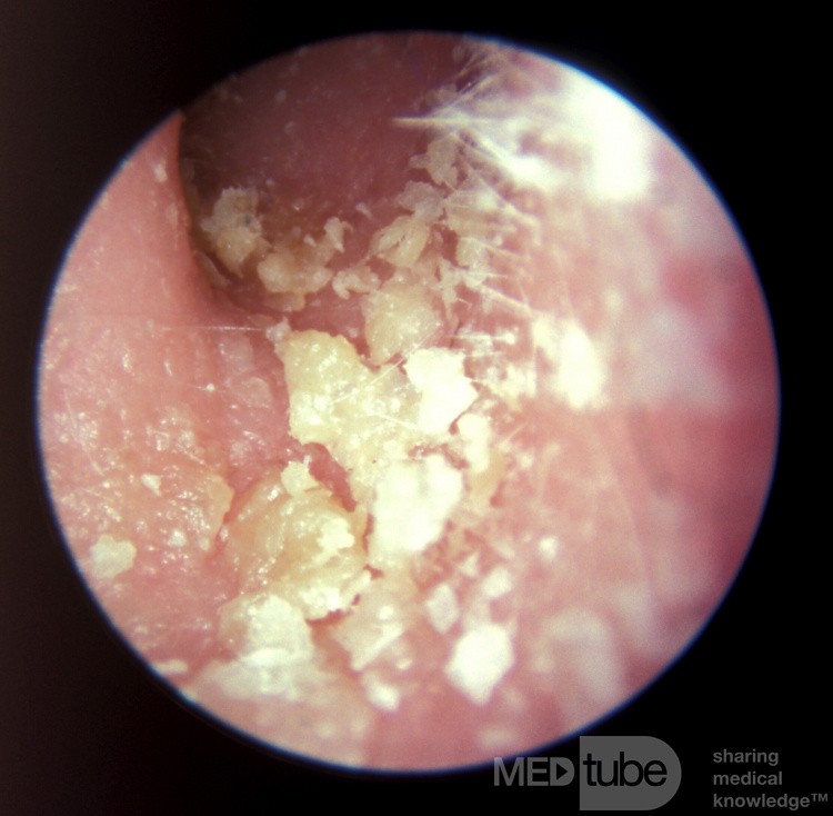 Psoriasis inside my ear canal, Giardiasis lichen planus