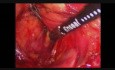 Laparoscopic Distal Pancreatectomy for Neuroendocrine Tumor of Pancreas