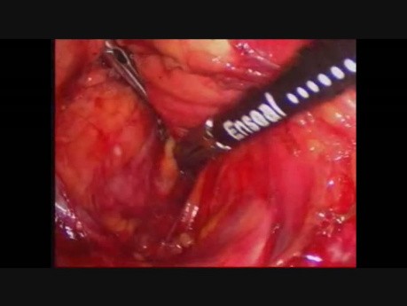 Laparoscopic Distal Pancreatectomy for Neuroendocrine Tumor of Pancreas
